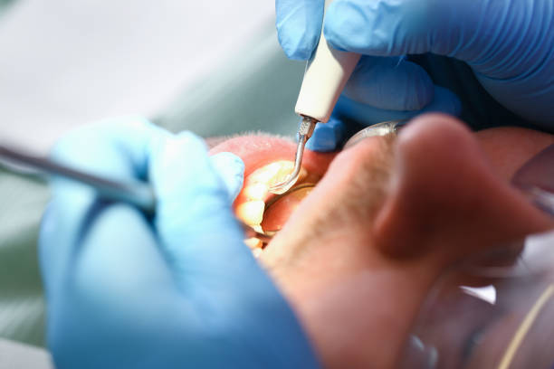 Best Emergency Root Canal Therapy in Rock Hill, MO